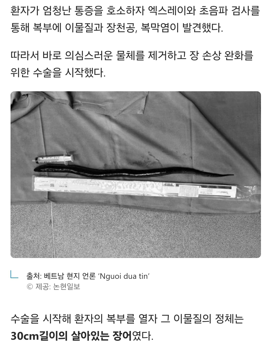 더쿠 항문으로… 응급실 온 남성 배 속에서 꺼낸 충격적인 생물 경악