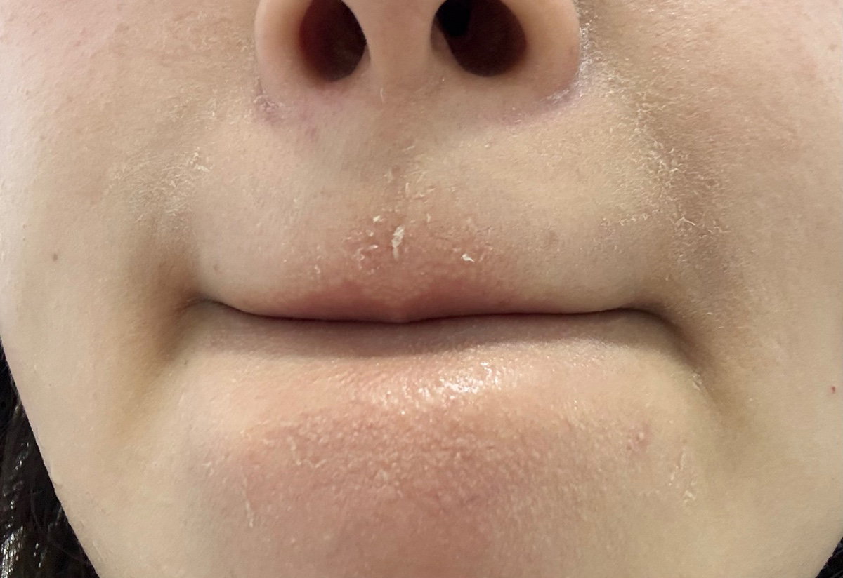 hPLntl